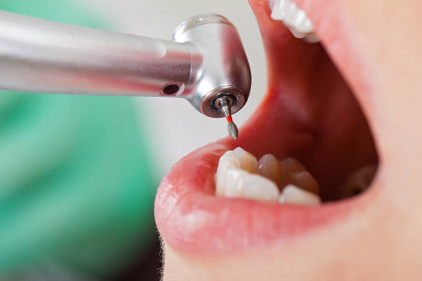 Best Emergency Treatment for Dental Infections or Abscesses in Lipatria, CA